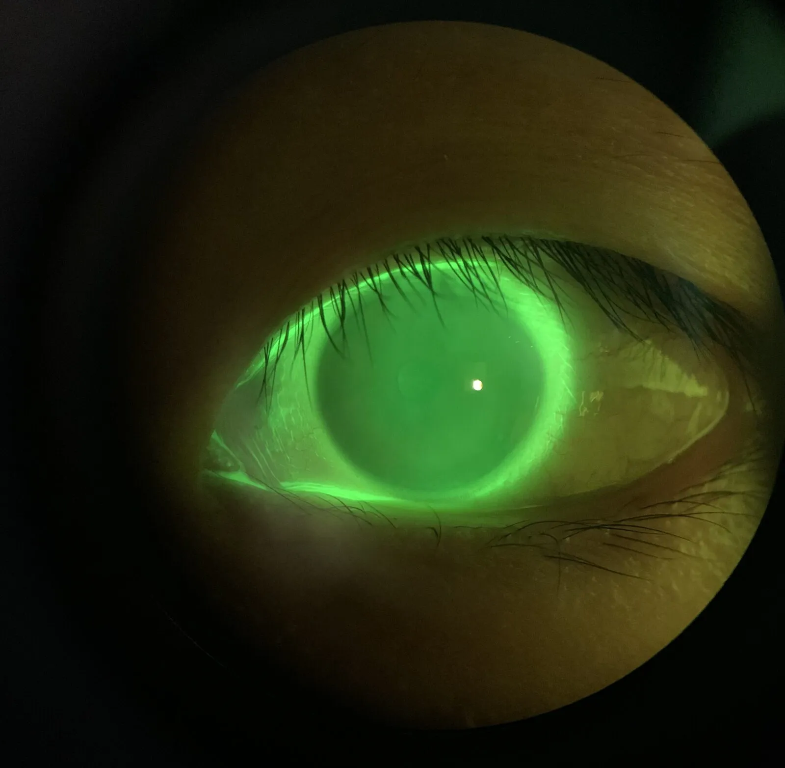 is-orthokeratology-safe-emme