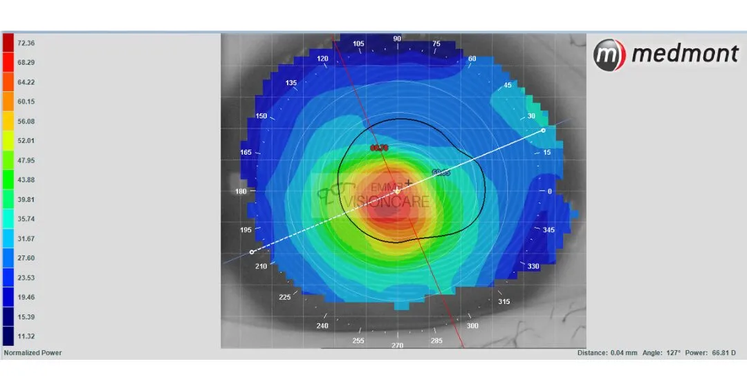 keratoconus_corneal_topography_emme_visioncare