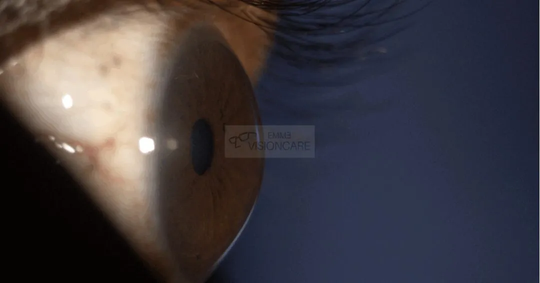 keratoconus_photo_emme_visioncare