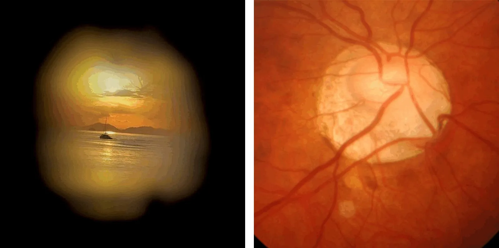 glaucoma page